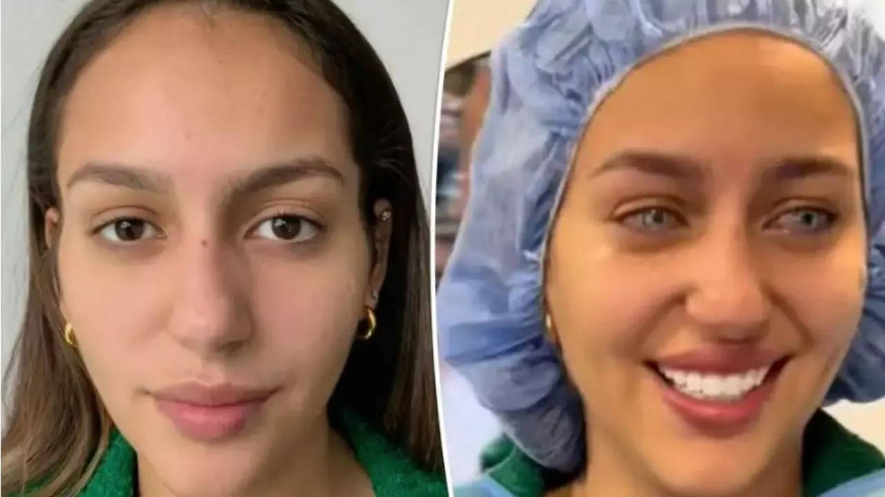 Woman shared photo of her keratopigmentation done last year on TikTok Pic New York Post